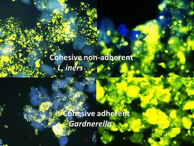 Clue Cells and Pseudo Clue Cells in Different Morphotypes of Bacterial Vaginosis